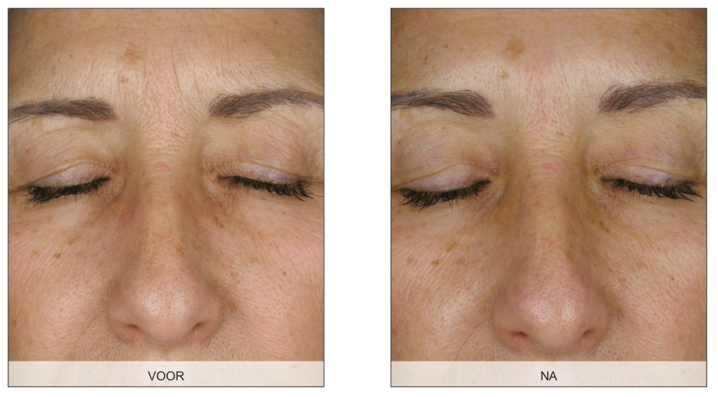 Endermologie voor het gezicht