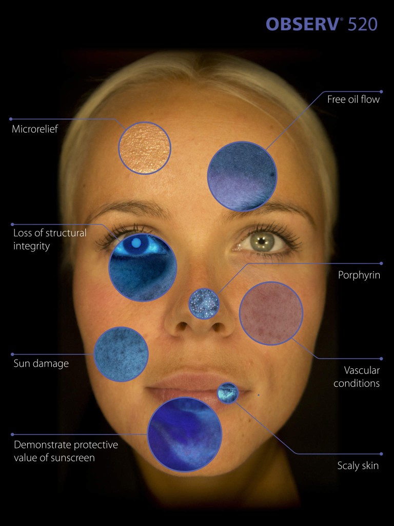 Voorbeeld van een huidanalyse met de Observ