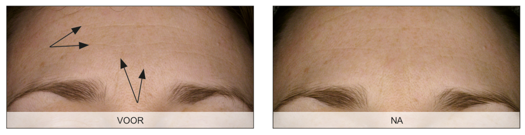 Endermologie voor het gezicht