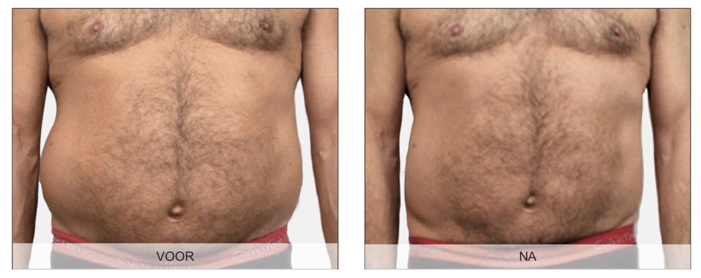 Endermologie voor het lichaam