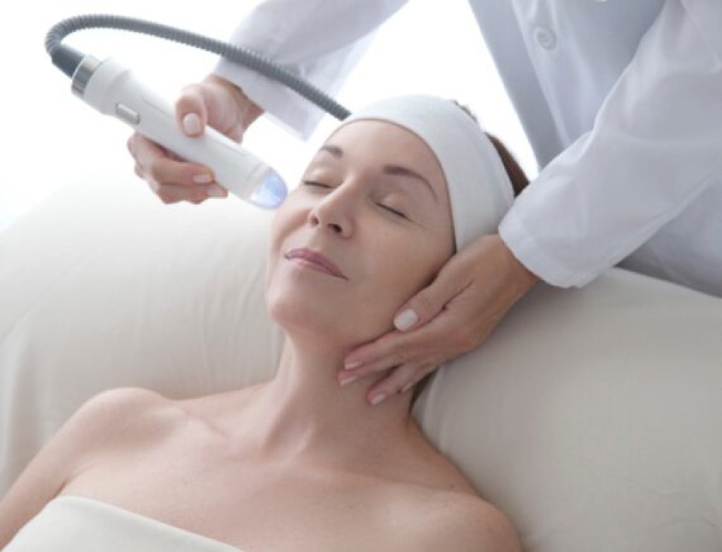 Vivace RF microneedling