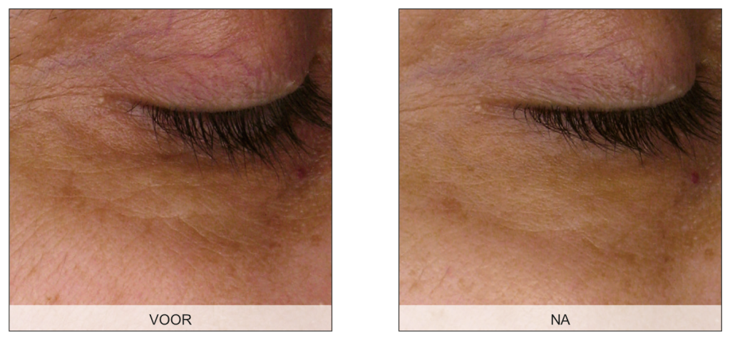 Endermologie voor het gezicht