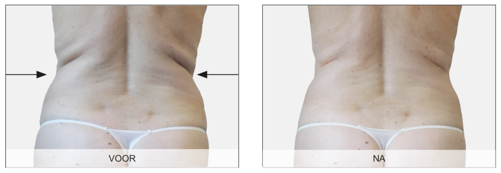 Endermologie voor het lichaam