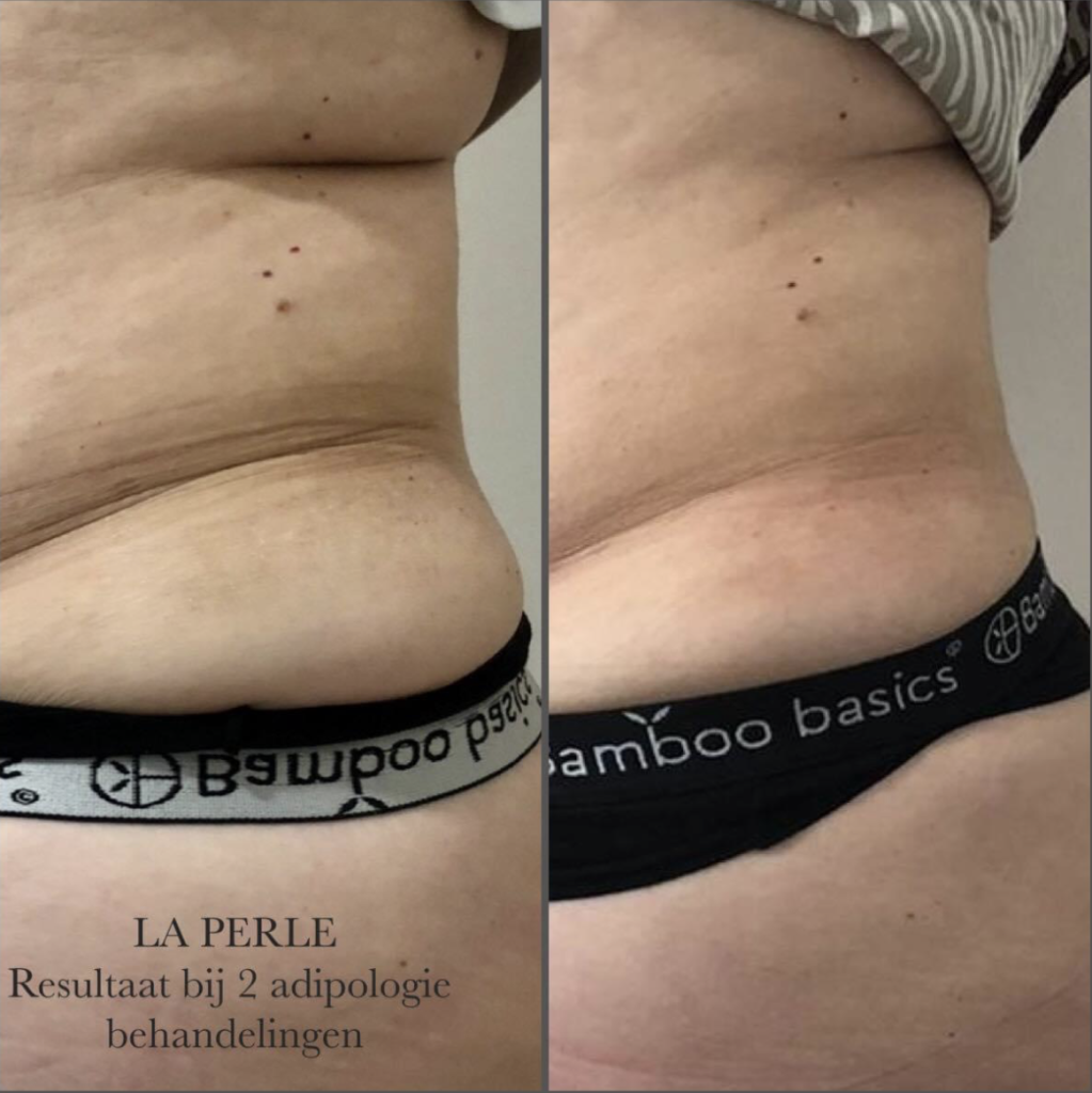 Adipologie behandeling