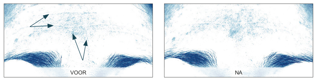 Endermologie voor het gezicht
