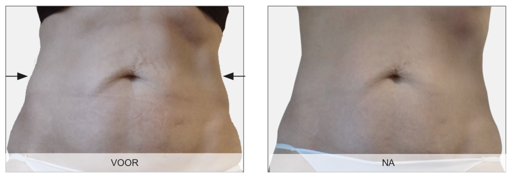 Endermologie voor het lichaam