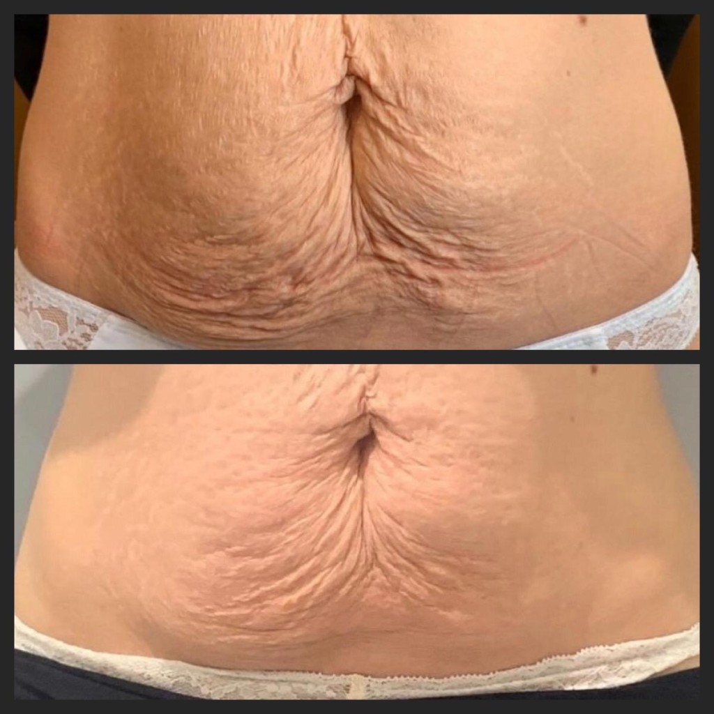 Adipologie behandeling